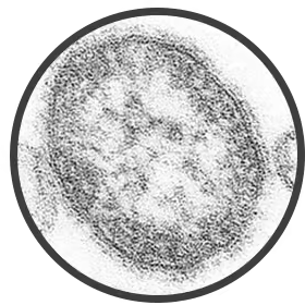 measles